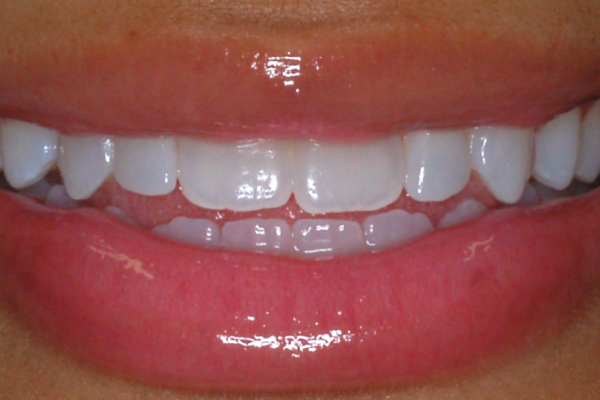 AS Smile after
