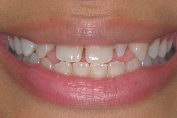 AS Smile before