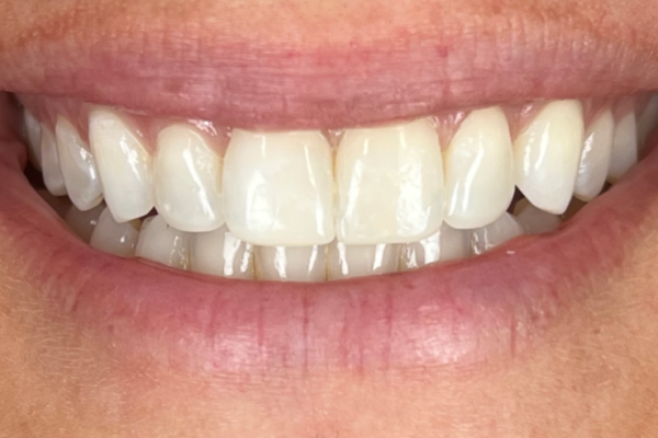 CB Smile After