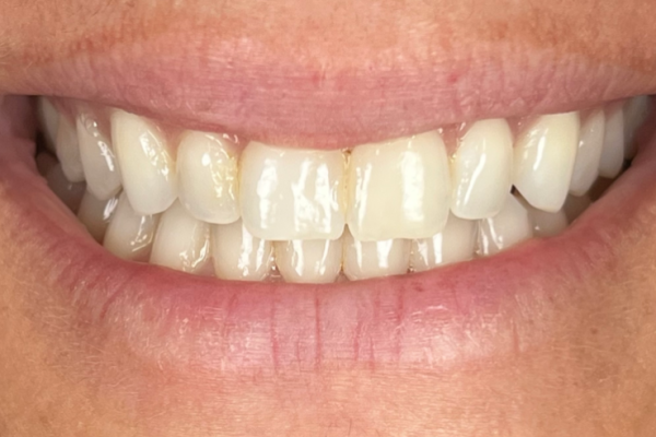 CB Smile Before