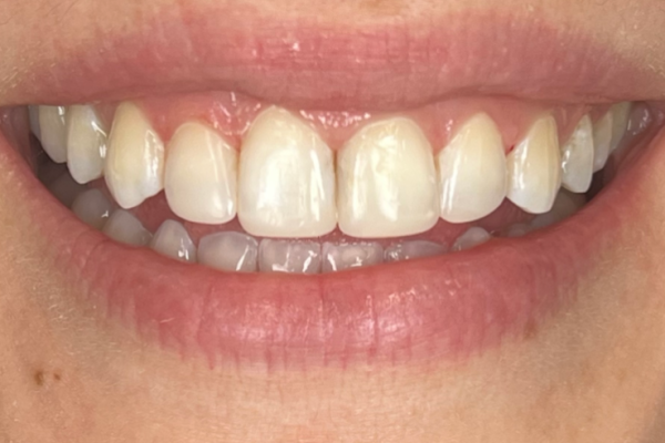 EH Smile After
