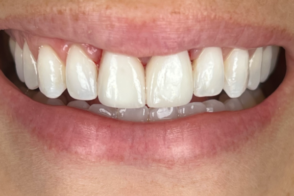 GP Smile After