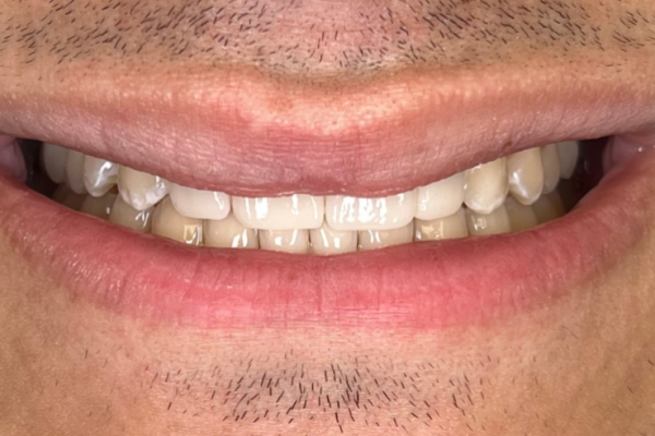 JM Smile After