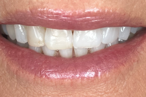 KP Smile Before