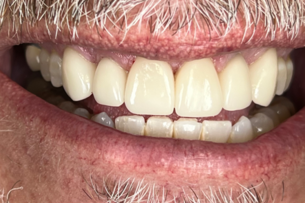 MG Smile After