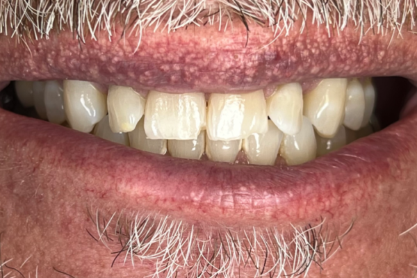 MG Smile Before