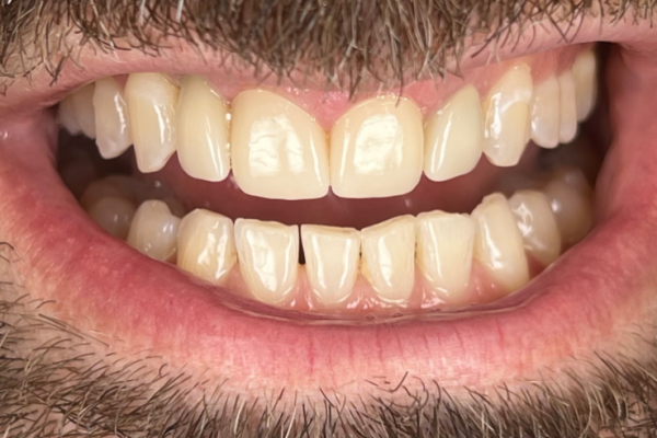 PH Smile After