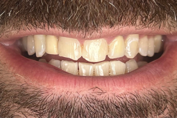 PH smile before