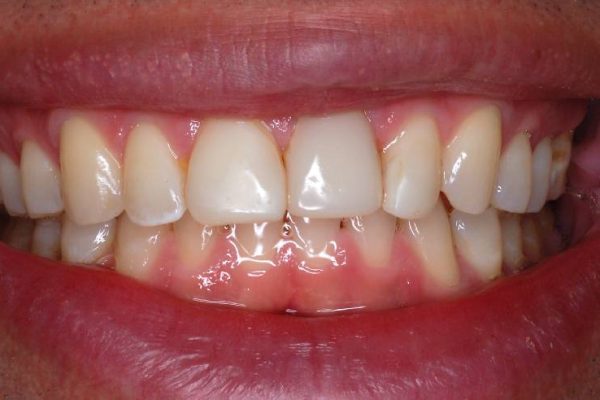 Veneers-before
