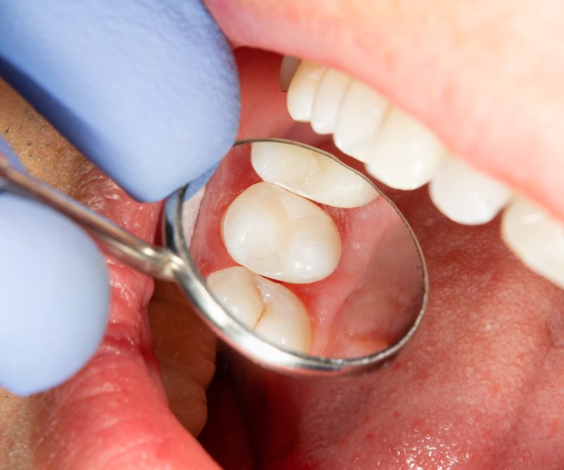 Close-up of a dentist using a dental mirror and instrument to examine a patient’s teeth during a routine dental treatment – Dental Treatment