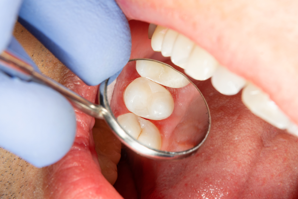 Close-up of a dentist using a dental mirror and instrument to examine a patient’s teeth during a routine dental treatment – Dental Treatment