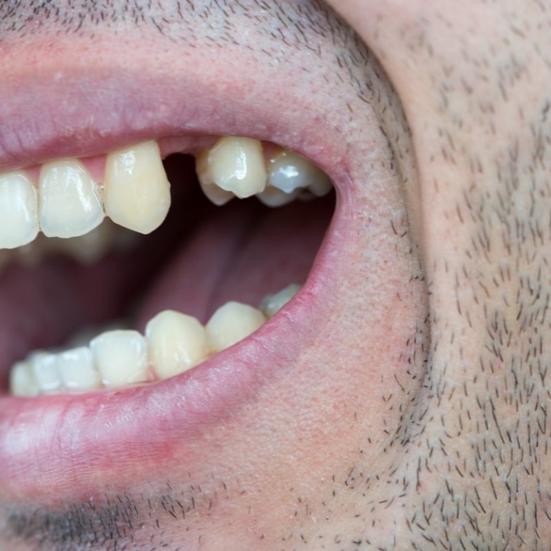 Close-up of a person’s open mouth showing a missing tooth on the side between natural teeth – missing tooth on the side